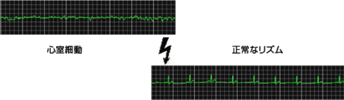 心室細動　⇒　正常なリズム