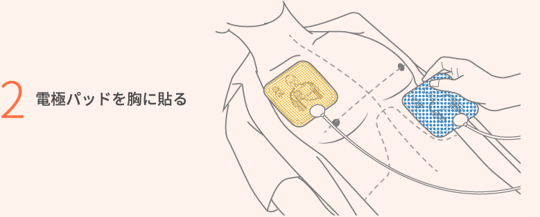 電極パッドを胸に貼る